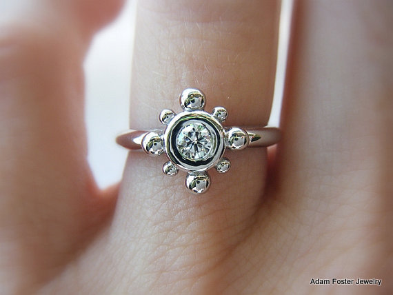 Wedding ring dermatitis